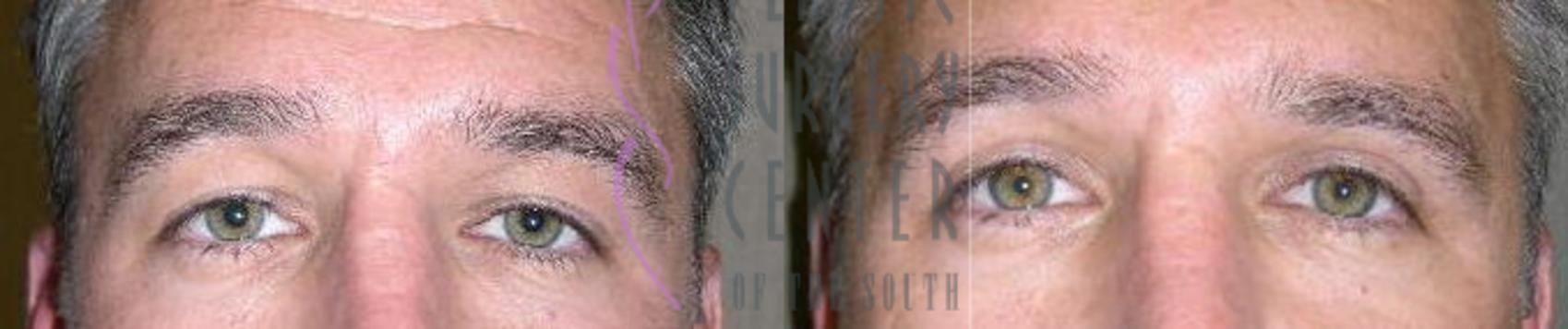Plastic Surgery Center of the South blepharoplasty result — Marietta, GA