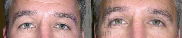 Blepharoplasty result at Plastic Surgery Center of the South in Marietta, GA