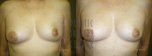 Breast Augmentation result at Plastic Surgery Center of the South in Marietta, GA