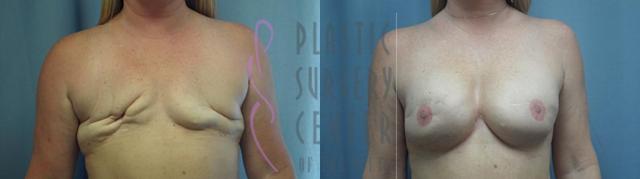 Breast Augmentation result at Plastic Surgery Center of the South in Marietta, GA