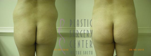 Brazilian Butt Lift result at Plastic Surgery Center of the South in Marietta, GA