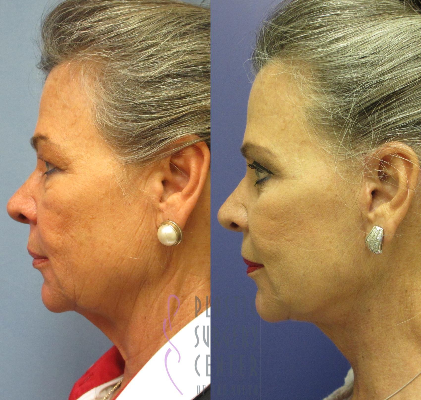 Plastic Surgery Center of the South neck lift result — Marietta, GA
