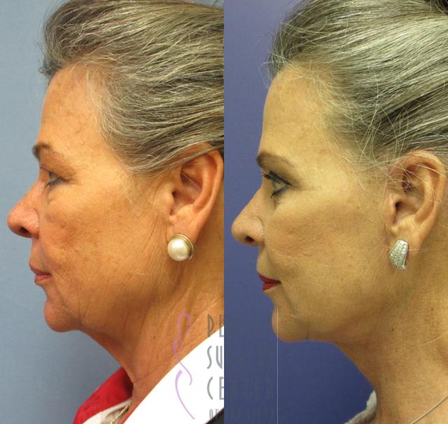 Neck Lift result at Plastic Surgery Center of the South in Marietta, GA