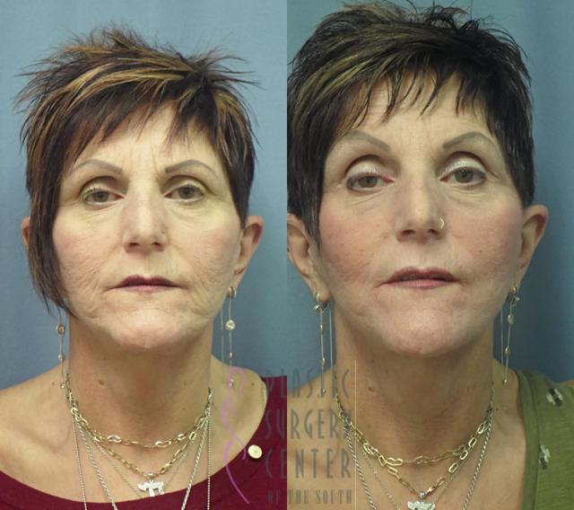 Neck Lift result at Plastic Surgery Center of the South in Marietta, GA