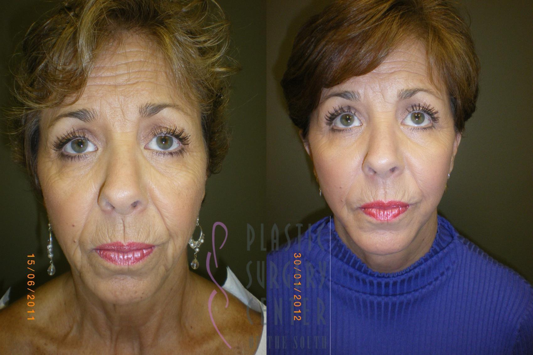 Plastic Surgery Center of the South blepharoplasty result — Marietta, GA