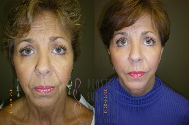 Blepharoplasty result at Plastic Surgery Center of the South in Marietta, GA