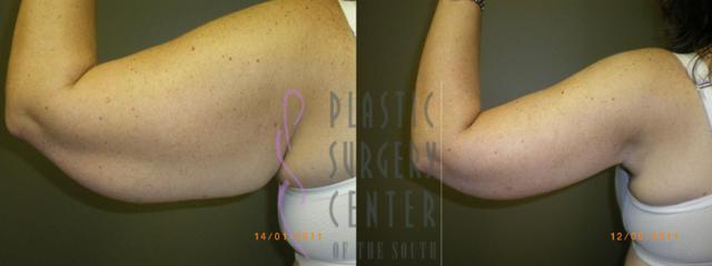 Liposuction result at Plastic Surgery Center of the South in Marietta, GA