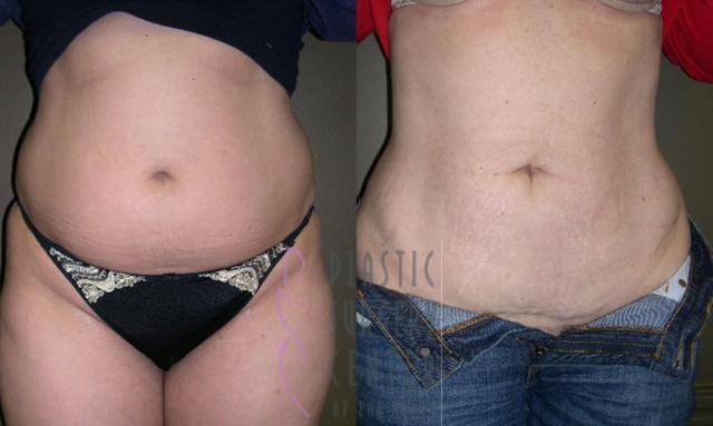 Liposuction result at Plastic Surgery Center of the South in Marietta, GA