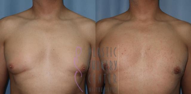 Gynecomastia Surgery result at Plastic Surgery Center of the South in Marietta, GA