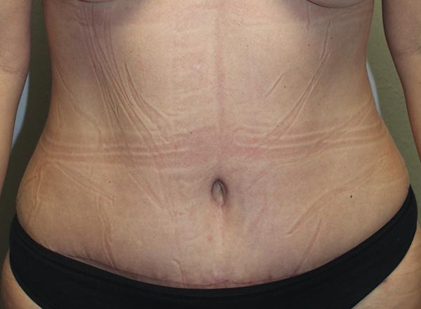 Tummy Tuck after at Dr. Rai: Cosmetic Surgical Center in Dallas, TX