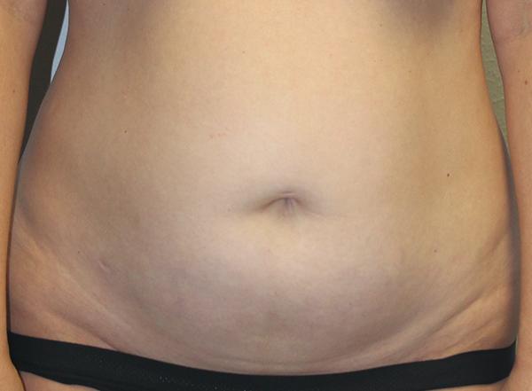 Tummy Tuck before at Dr. Rai: Cosmetic Surgical Center in Dallas, TX