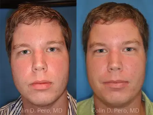 Liquid Rhinoplasty result at North Texas Facial Plastic Surgery in Dallas, TX