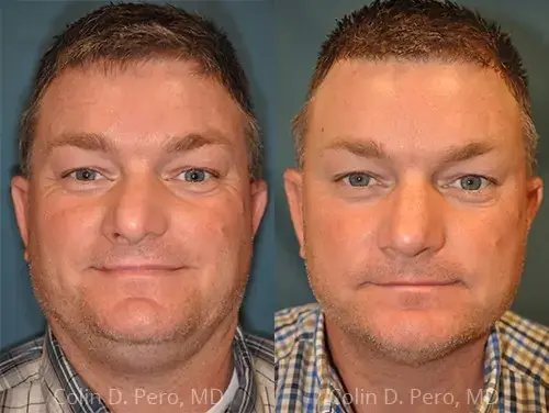 Liquid Rhinoplasty result at North Texas Facial Plastic Surgery in Dallas, TX