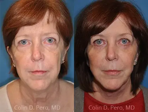 Facelift result at North Texas Facial Plastic Surgery in Dallas, TX