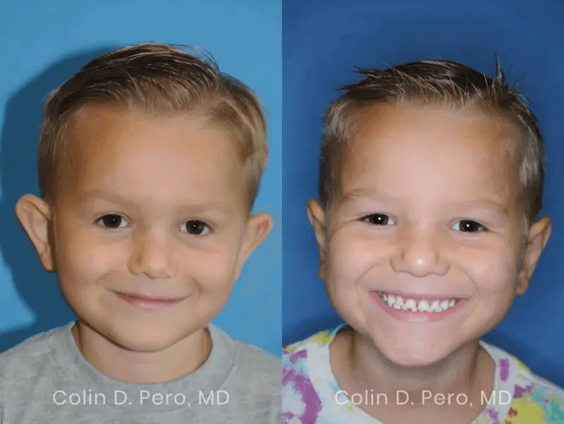 North Texas Facial Plastic Surgery result — Dallas, TX