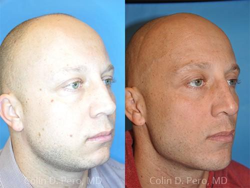 North Texas Facial Plastic Surgery result — Dallas, TX