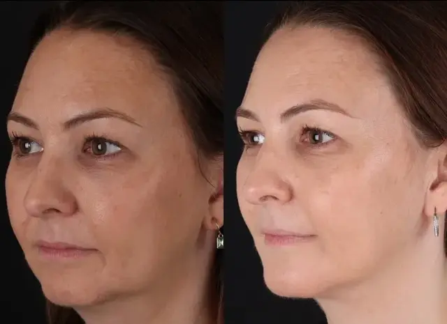 Chin Implant result at John M. Shamoun, M.D. FACS - Newport Beach Plastic Surgery in Newport Beach, CA