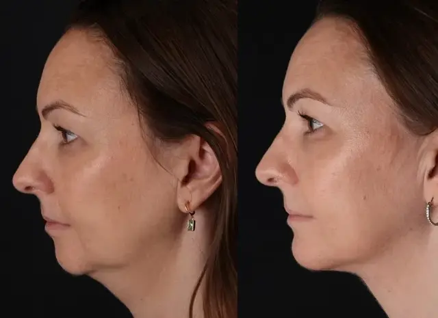 Chin Implant result at John M. Shamoun, M.D. FACS - Newport Beach Plastic Surgery in Newport Beach, CA