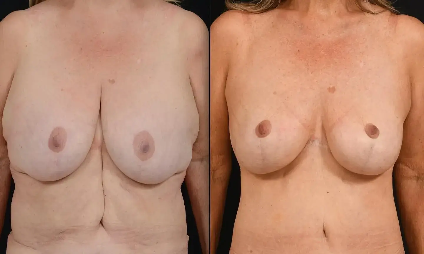 John M. Shamoun, M.D. FACS - Newport Beach Plastic Surgery body contouring result — Newport Beach, CA