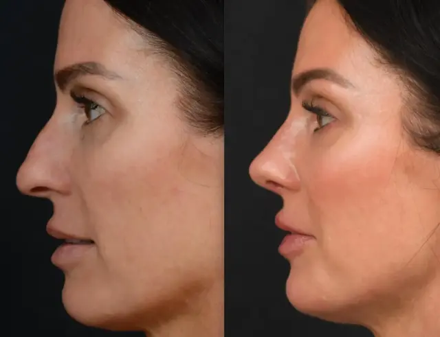 Rhinoplasty result at John M. Shamoun, M.D. FACS - Newport Beach Plastic Surgery in Newport Beach, CA