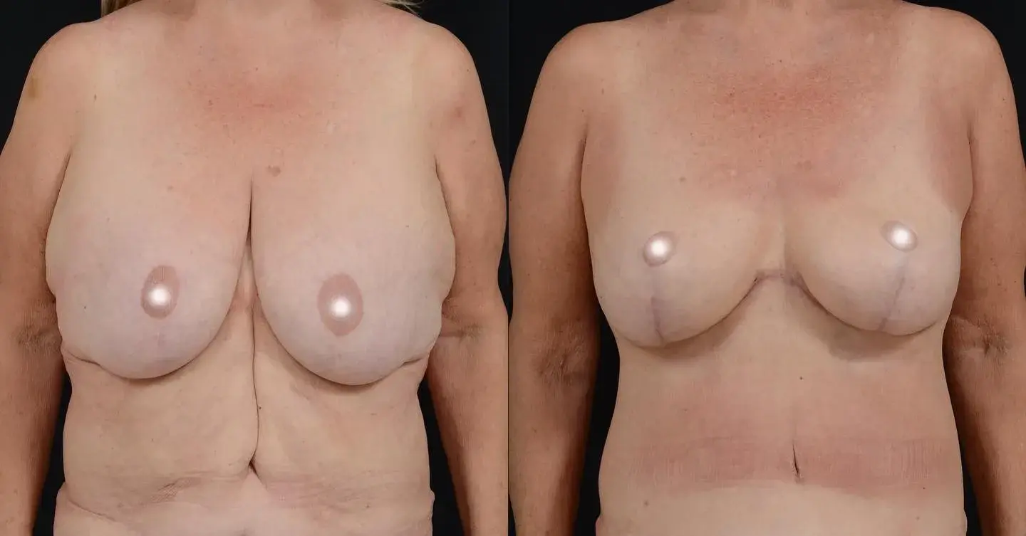 John M. Shamoun, M.D. FACS - Newport Beach Plastic Surgery breast lift result — Newport Beach, CA
