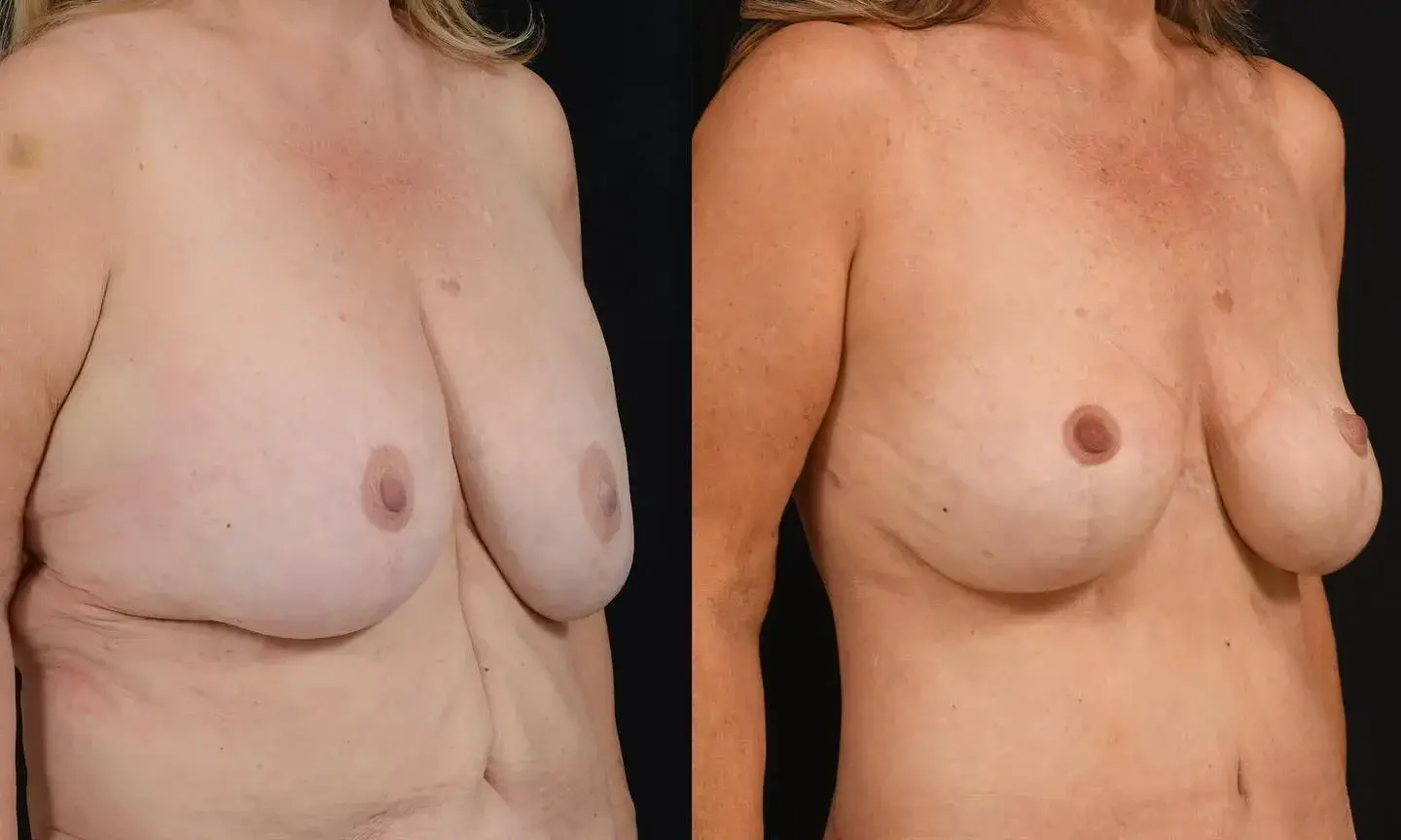 John M. Shamoun, M.D. FACS - Newport Beach Plastic Surgery body contouring result — Newport Beach, CA