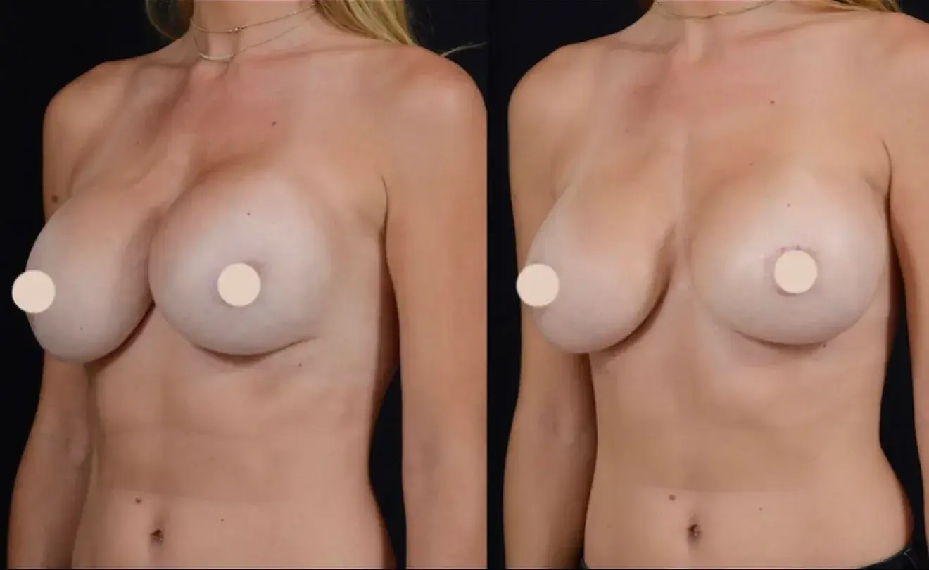 John M. Shamoun, M.D. FACS - Newport Beach Plastic Surgery breast augmentation revision result — Newport Beach, CA