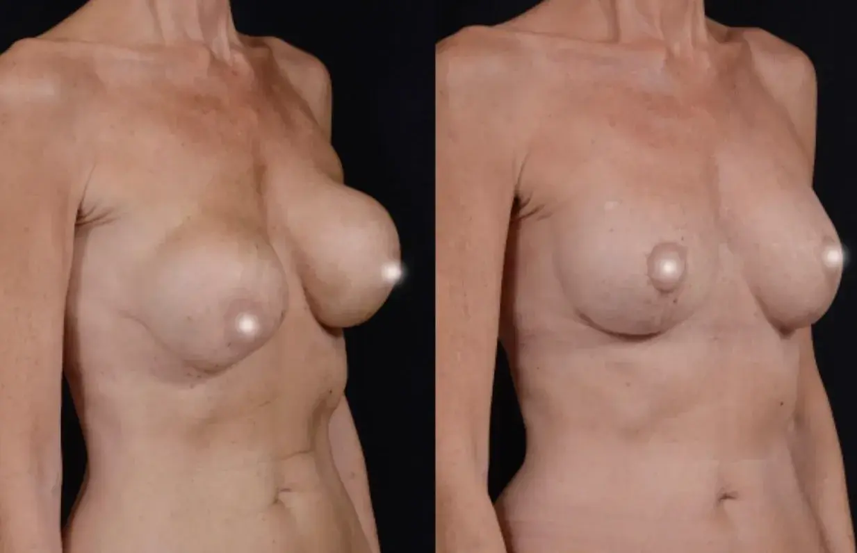 John M. Shamoun, M.D. FACS - Newport Beach Plastic Surgery breast augmentation revision result — Newport Beach, CA