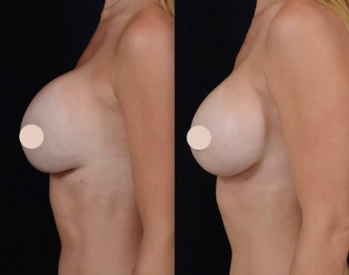 John M. Shamoun, M.D. FACS - Newport Beach Plastic Surgery breast augmentation revision result — Newport Beach, CA