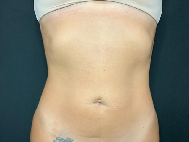 Liposuction before at Le Contour Aesthetic Surgery in Orlando, FL
