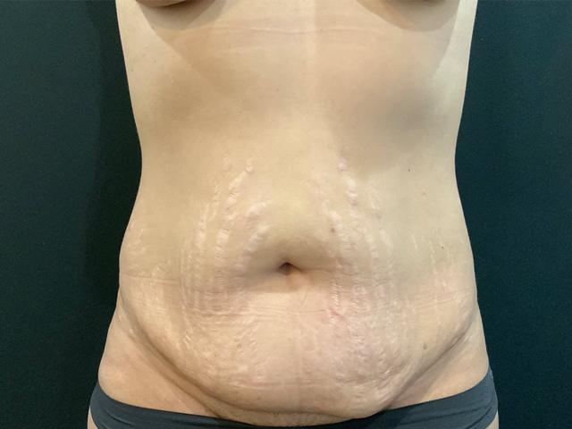 Mini Tummy Tuck before at Le Contour Aesthetic Surgery in Orlando, FL