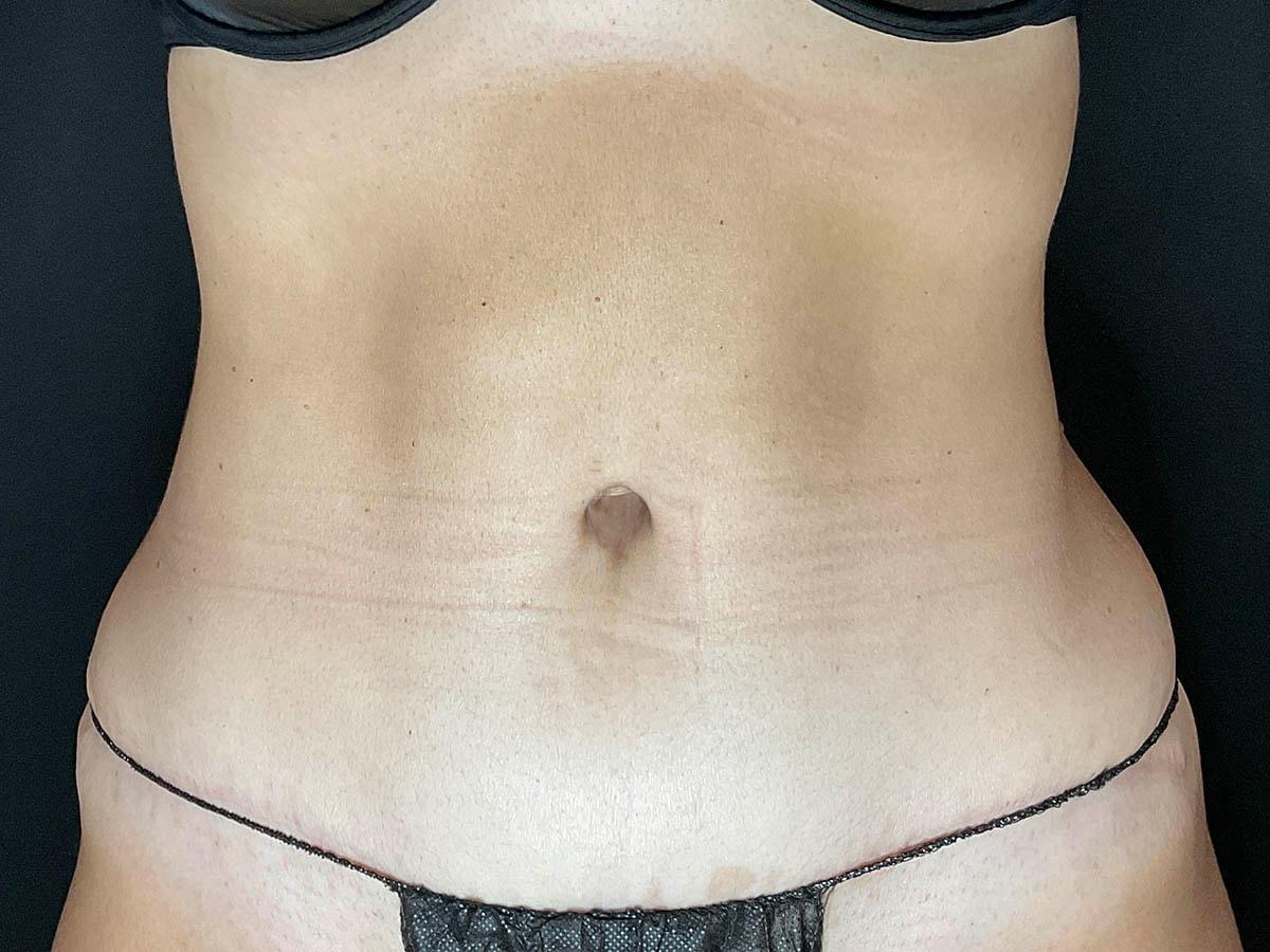 Le Contour Aesthetic Surgery tummy tuck after — Orlando, FL