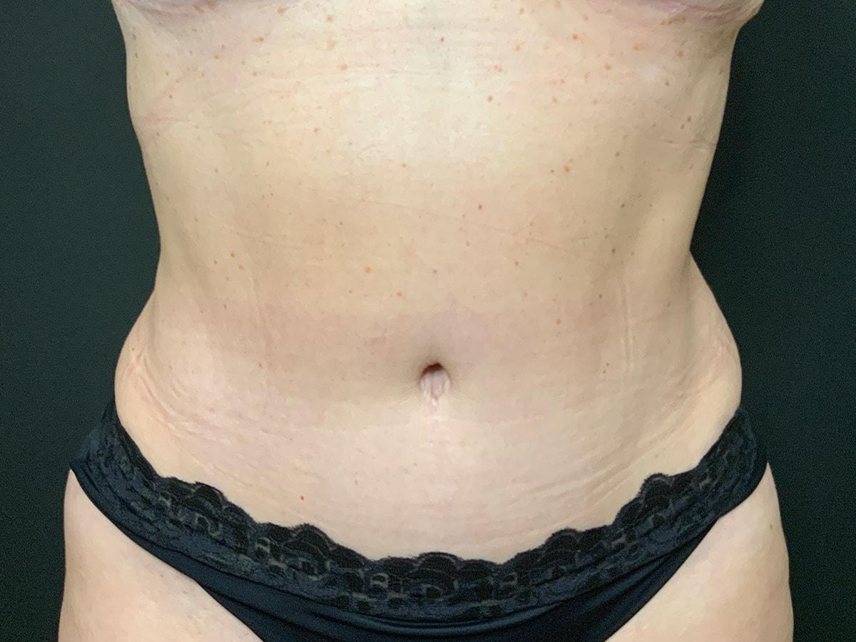 Le Contour Aesthetic Surgery tummy tuck after — Orlando, FL