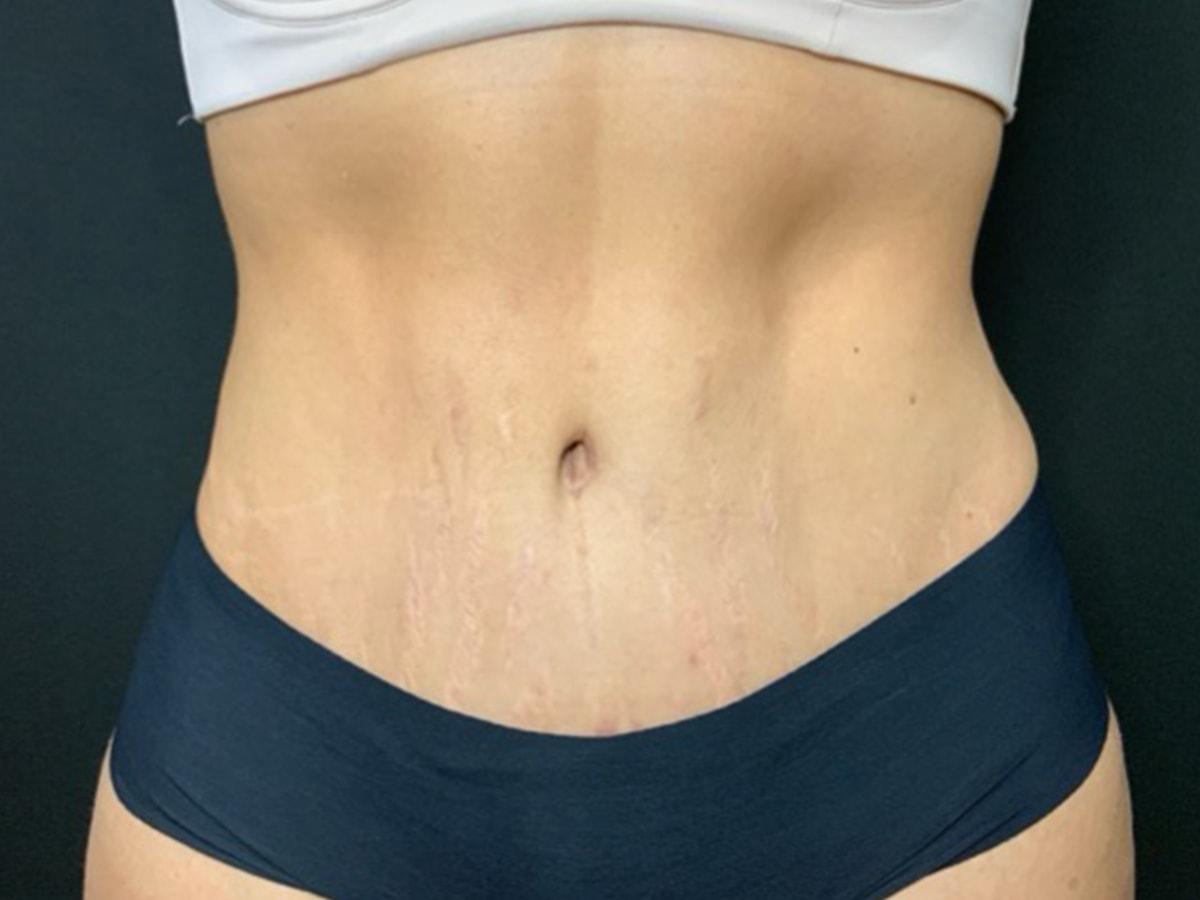 Le Contour Aesthetic Surgery tummy tuck after — Orlando, FL