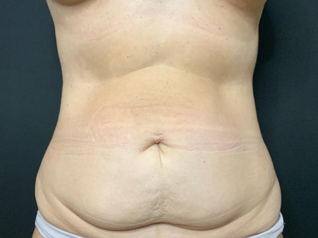 Mini Tummy Tuck before at Le Contour Aesthetic Surgery in Orlando, FL