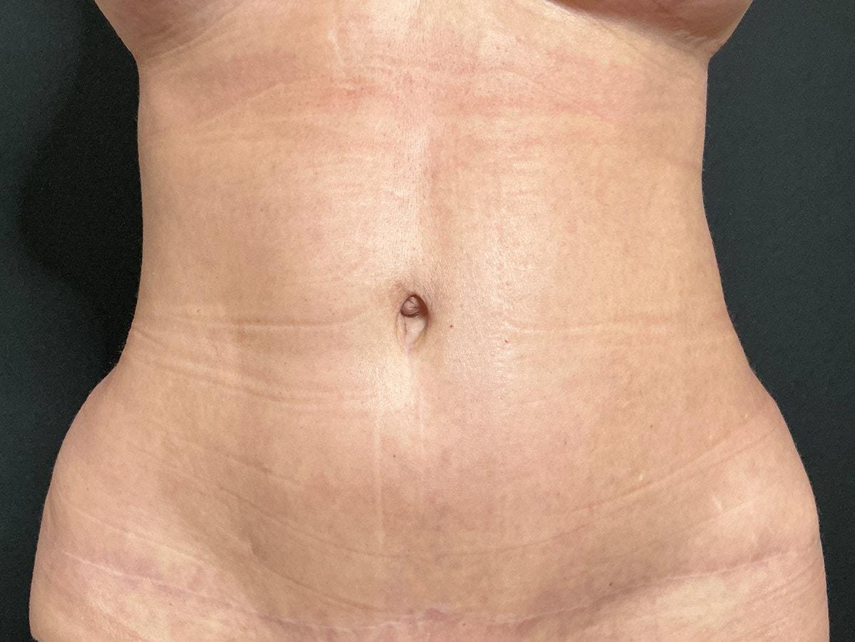 Le Contour Aesthetic Surgery tummy tuck after — Orlando, FL