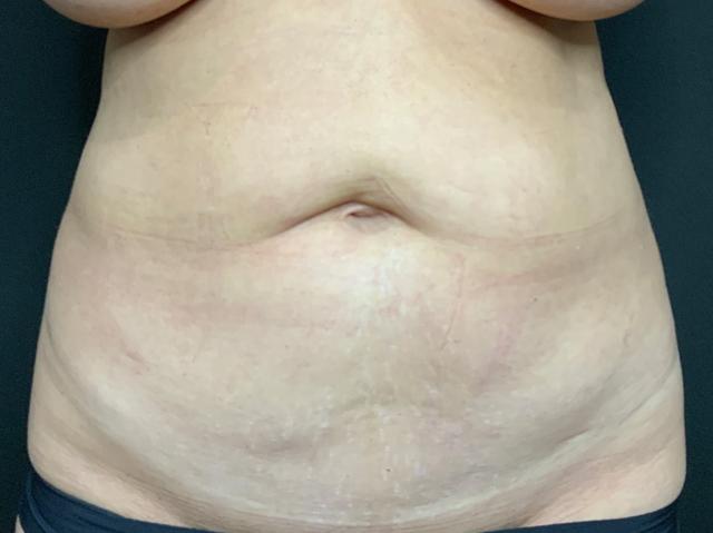 Mini Tummy Tuck before at Le Contour Aesthetic Surgery in Orlando, FL