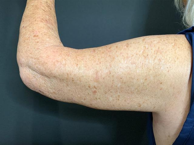 Arm Lift after at Le Contour Aesthetic Surgery in Orlando, FL