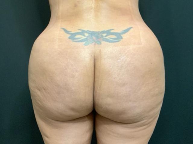 Brazilian Butt Lift after at Le Contour Aesthetic Surgery in Orlando, FL