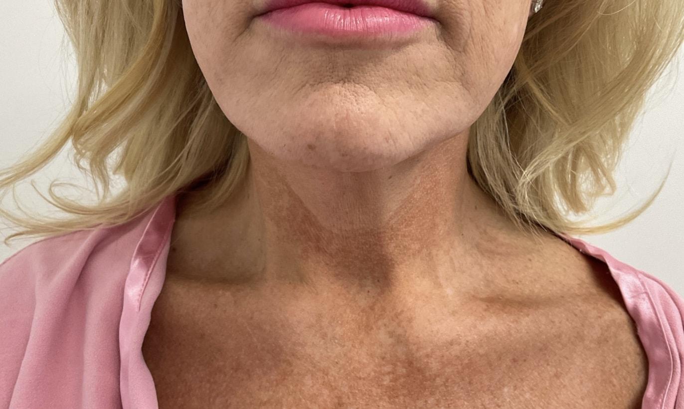 Angela Champion, MD neck lift after — Newport Beach, CA