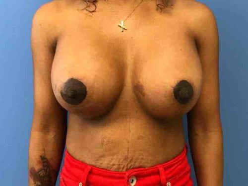 Angela Champion, MD breast lift after — Newport Beach, CA