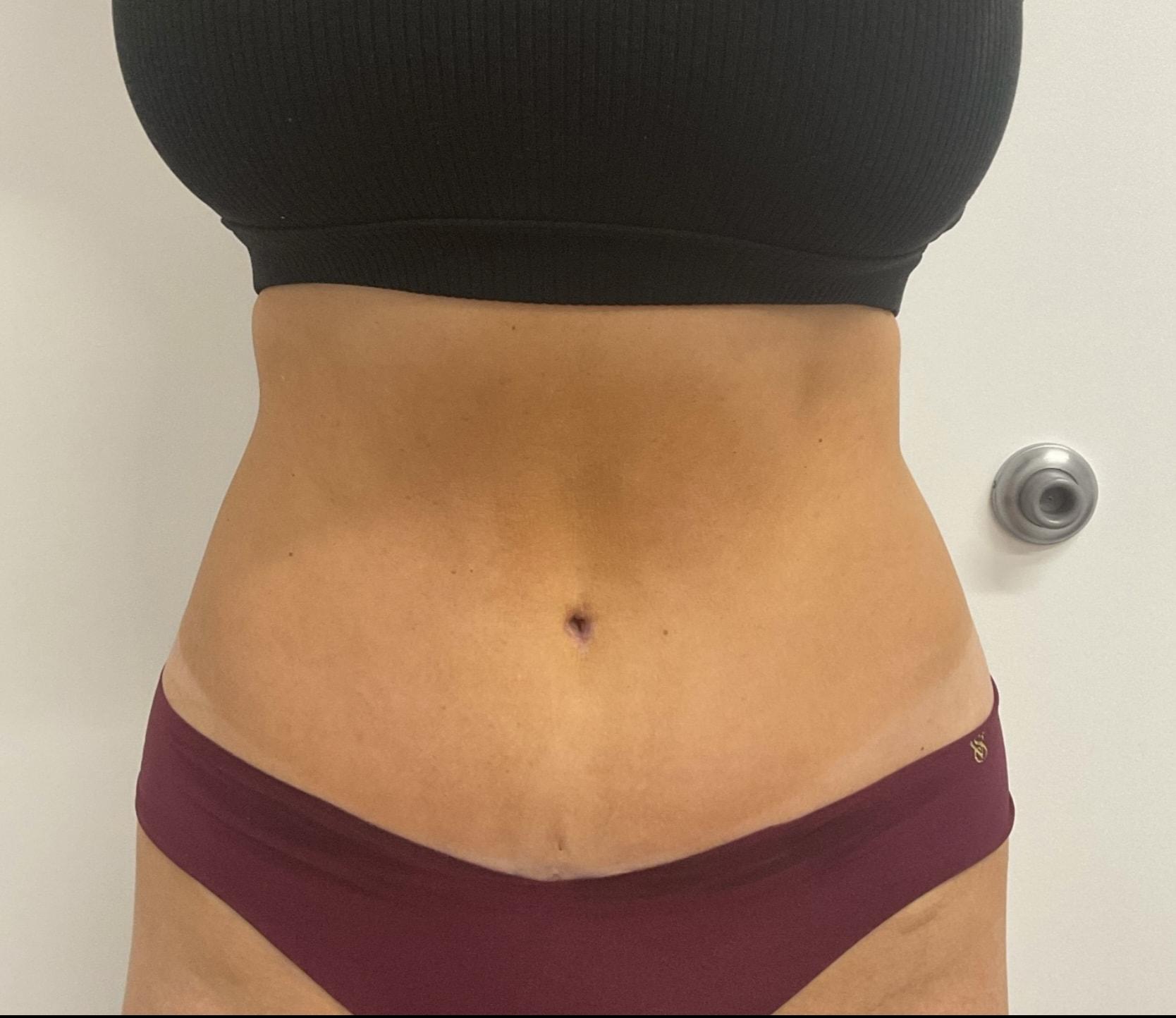 Angela Champion, MD liposuction after — Newport Beach, CA