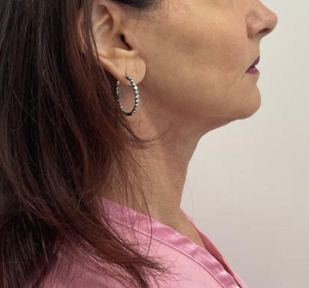 Angela Champion, MD neck lift after — Newport Beach, CA