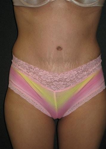 Angela Champion, MD tummy tuck after — Newport Beach, CA