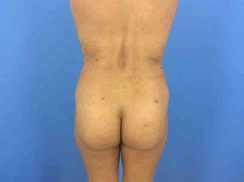Angela Champion, MD liposuction after — Newport Beach, CA