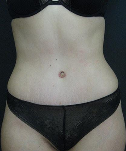Angela Champion, MD tummy tuck after — Newport Beach, CA