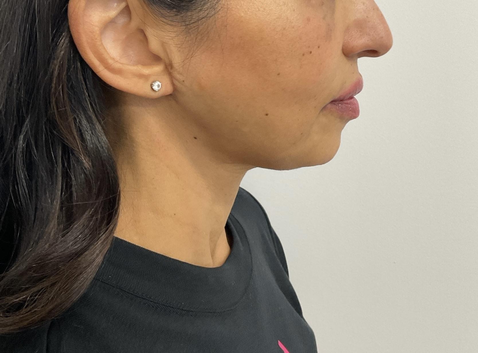 Angela Champion, MD neck lift after — Newport Beach, CA