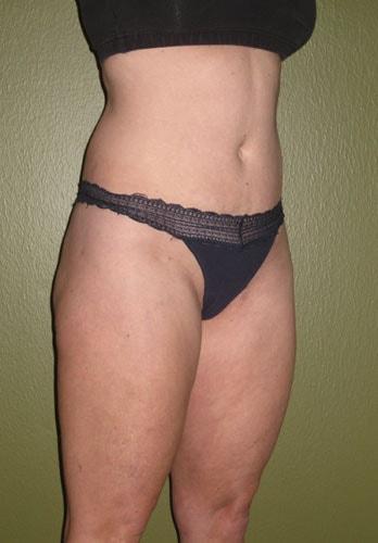 Angela Champion, MD liposuction after — Newport Beach, CA