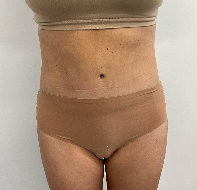 Angela Champion, MD tummy tuck after — Newport Beach, CA