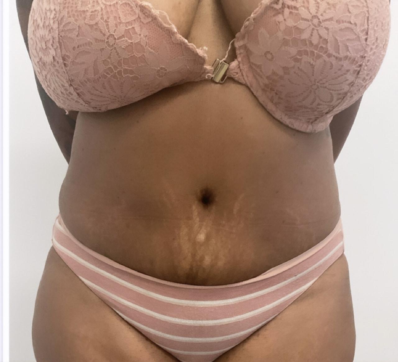 Angela Champion, MD liposuction after — Newport Beach, CA